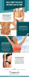 Campanile How a Tummy Tuck Can Do Way More Than You Think