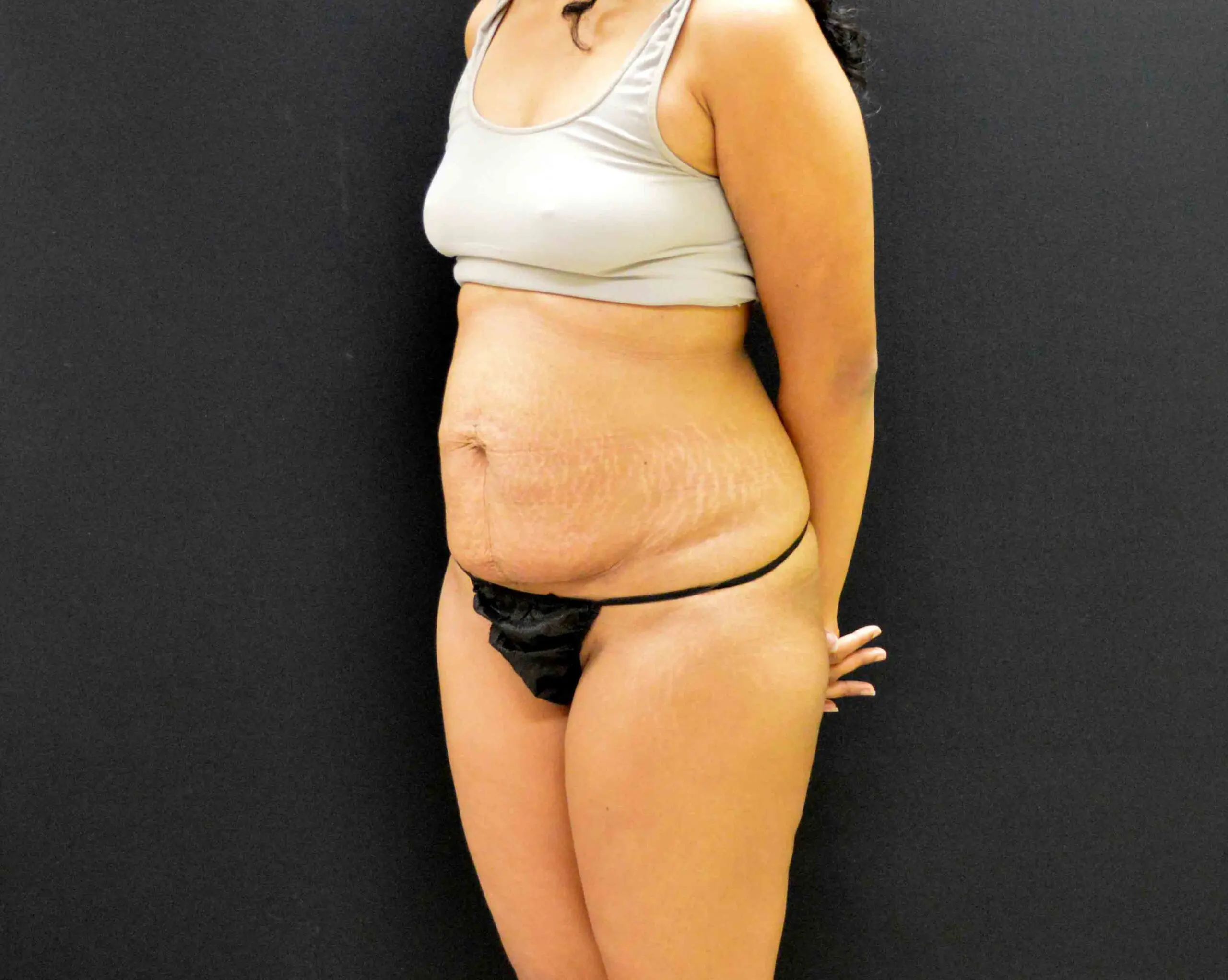 C.L.A.S.S. Tummy Tuck™ - Case 314 - Before