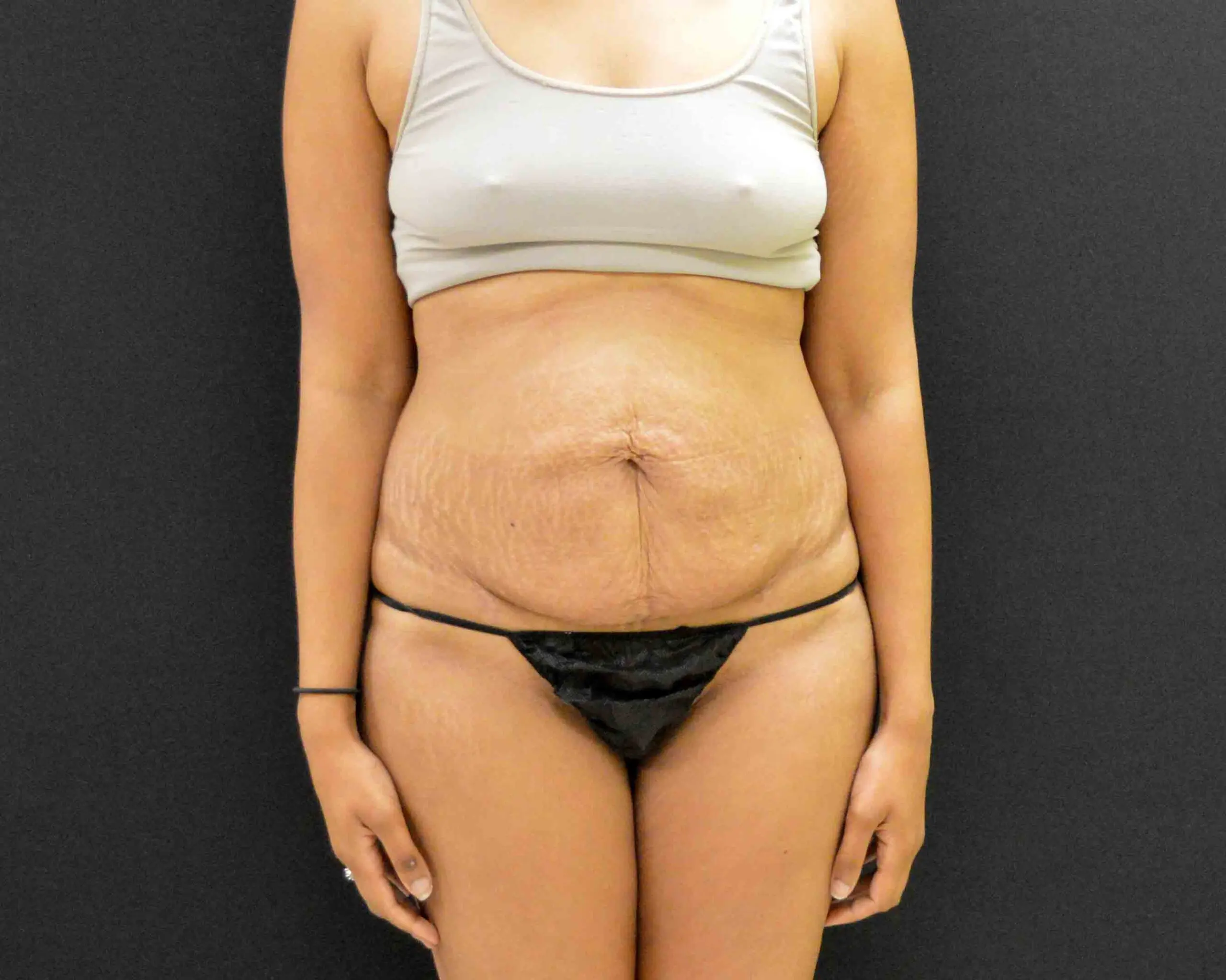 C.L.A.S.S. Tummy Tuck™ - Case 313 - Before