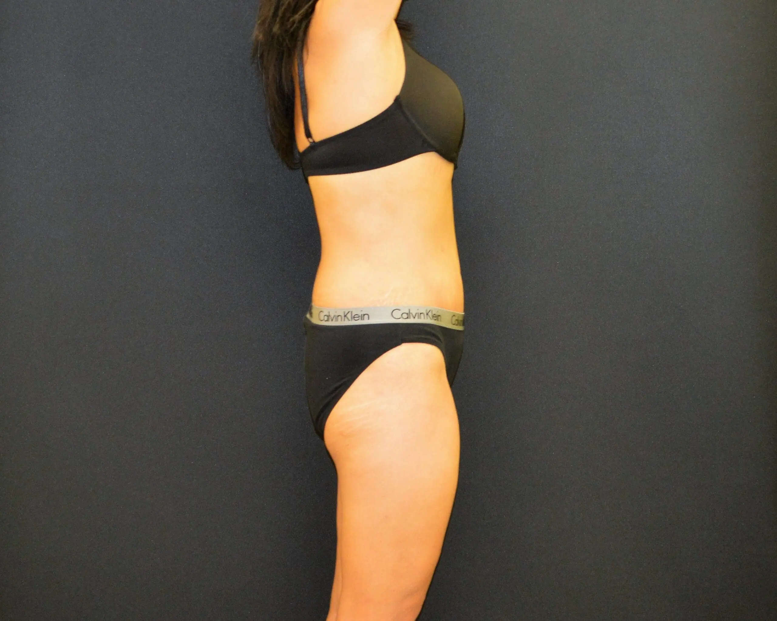 C.L.A.S.S. Tummy Tuck™ - Case 13117 - After