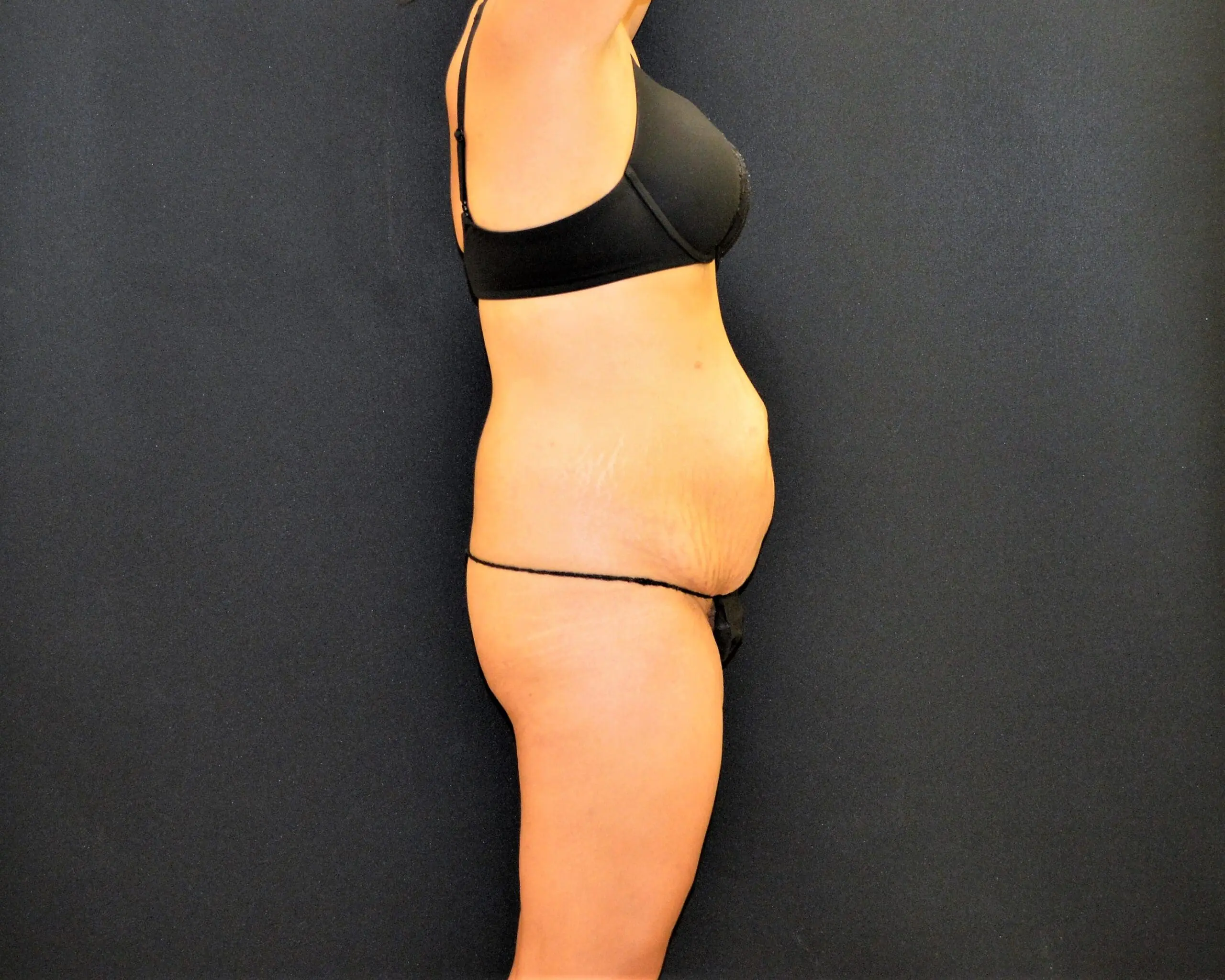 C.L.A.S.S. Tummy Tuck™ - Case 13117 - Before