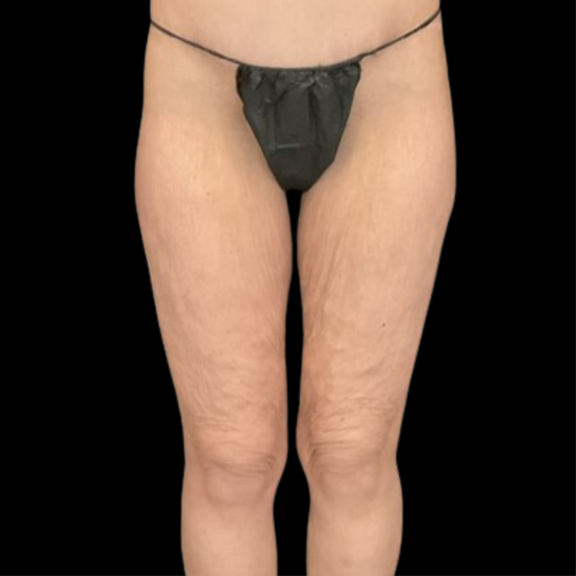 After Massive Weight Loss - Case 15277 - Before