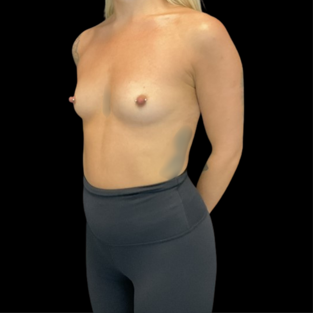 Breast Augmentation - Case 15429 - Before