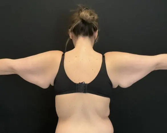 Arm Lift - Case 15761 - Before