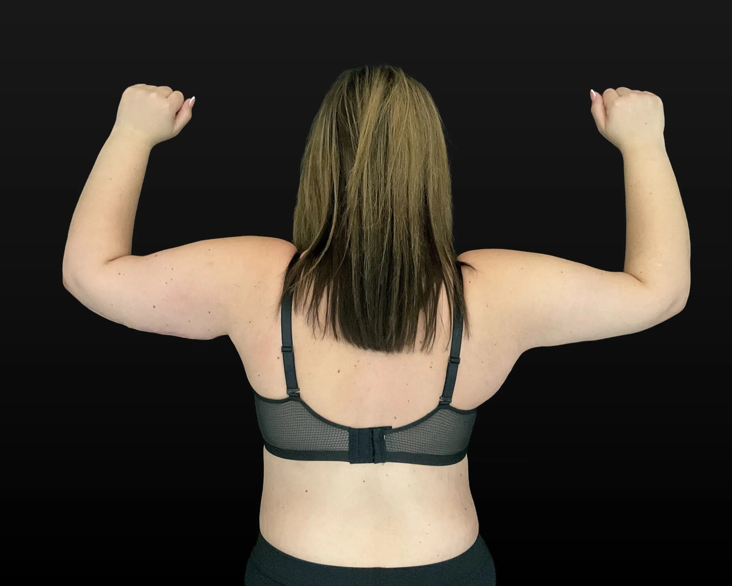 After Massive Weight Loss - Case 15765 - After