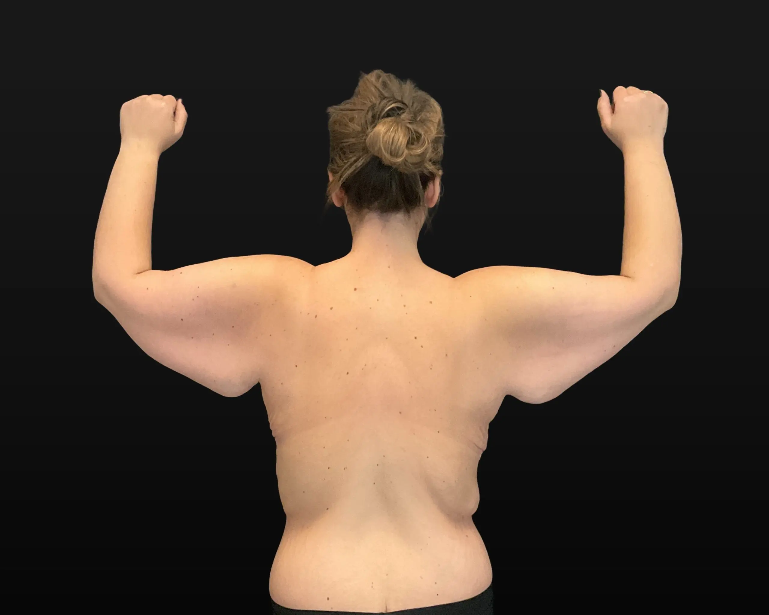 After Massive Weight Loss - Case 15765 - Before