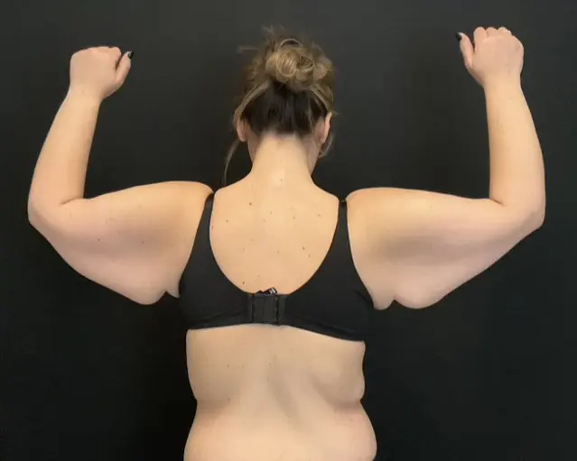 Arm Lift - Case 15769 - Before