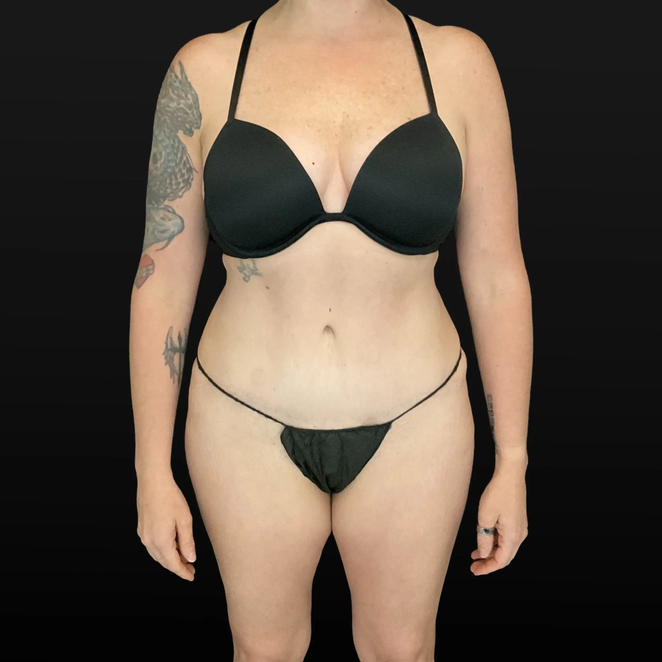 C.L.A.S.S. Tummy Tuck™ - Case 16129 - After