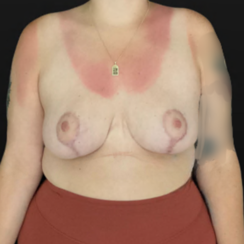 Breast Reduction - Case 16299 - After