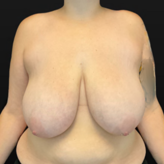 Breast Reduction - Case 16299 - Before