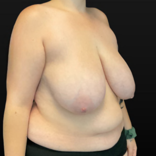 Breast Reduction - Case 16305 - Before