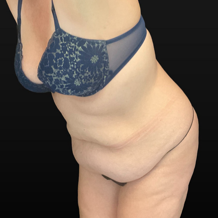 C.L.A.S.S. Tummy Tuck™ - Case 16357 - Before