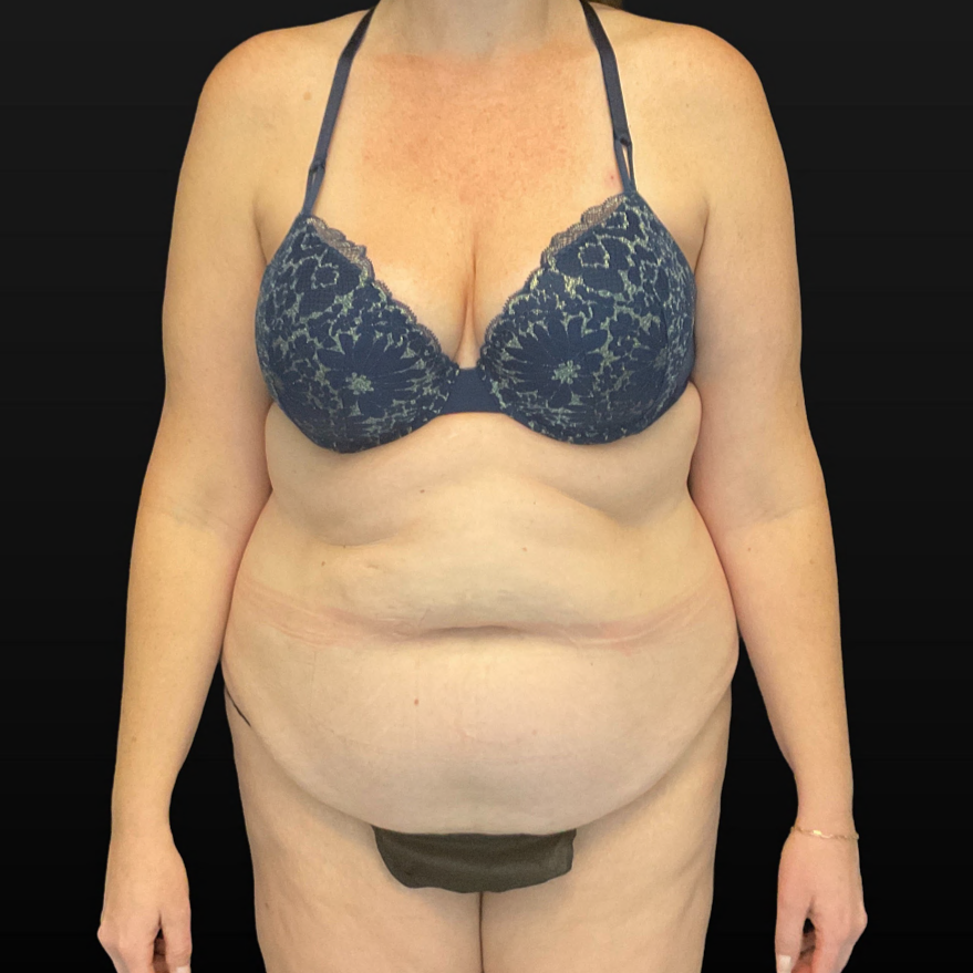 C.L.A.S.S. Tummy Tuck™ - Case 16361 - Before