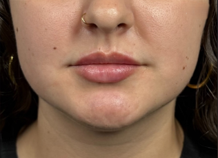 Medical Spa Procedures - Case 16417 - After