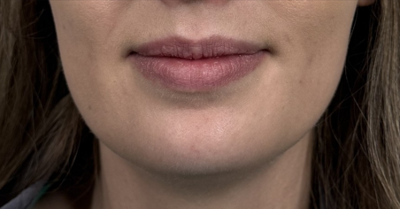 Medical Spa Procedures - Case 16422 - Before