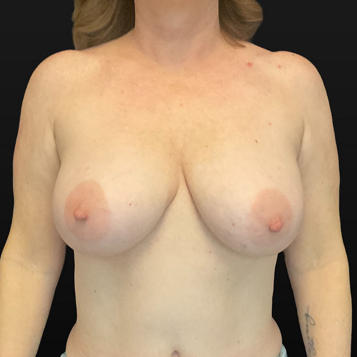 Breast Reduction - Case 16444 - Before