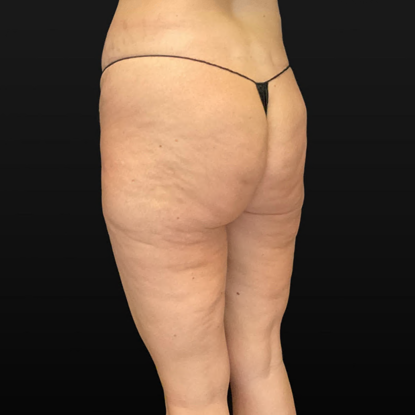 Lower Body Lift - Case 16474 - Before