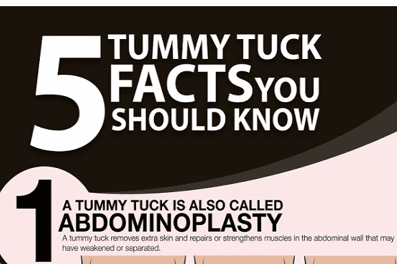 5 Facts Everyone Should Know about Tummy Tucks