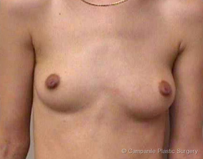 Breast Augmentation Patient Photo - Case 116 - before view-