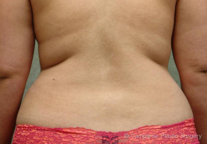 Liposuction Patient Photo - Case 58 - before view-