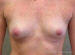 Breast Augmentation - Case 94 - Before