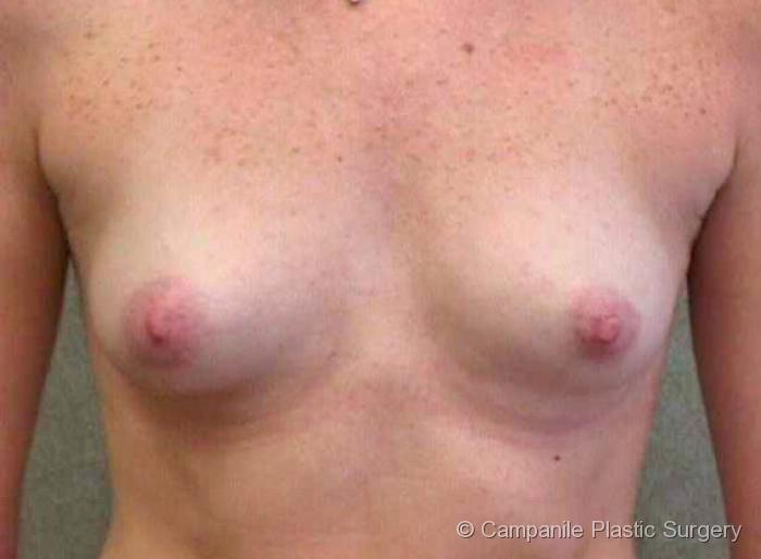 Breast Augmentation Patient Photo - Case 94 - before view-
