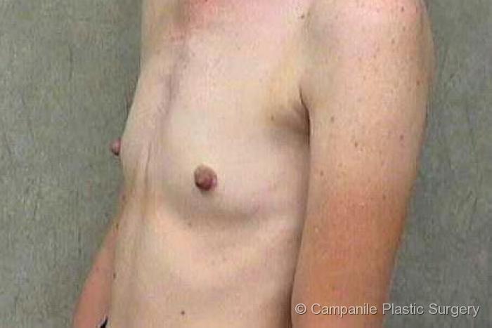 Breast Augmentation Patient Photo - Case 142 - before view-