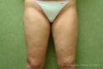 Liposuction - Case 62 - Before