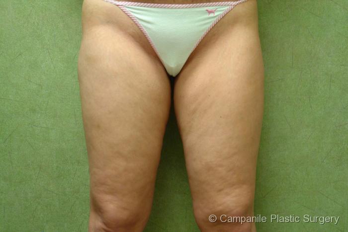 Liposuction Patient Photo - Case 62 - before view-0