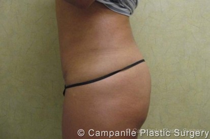 Mini Tummy Tuck Patient Photo - Case 47 - after view