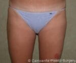Liposuction - Case 63 - After
