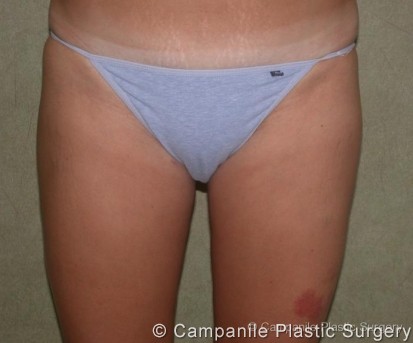 Liposuction Patient Photo - Case 63 - after view