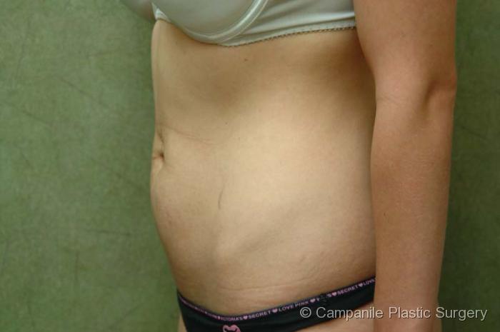 Mini Tummy Tuck Patient Photo - Case 49 - before view-