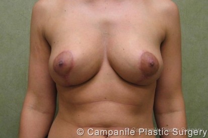 Breast Lift Patient Photo - Case 155 - after view-1