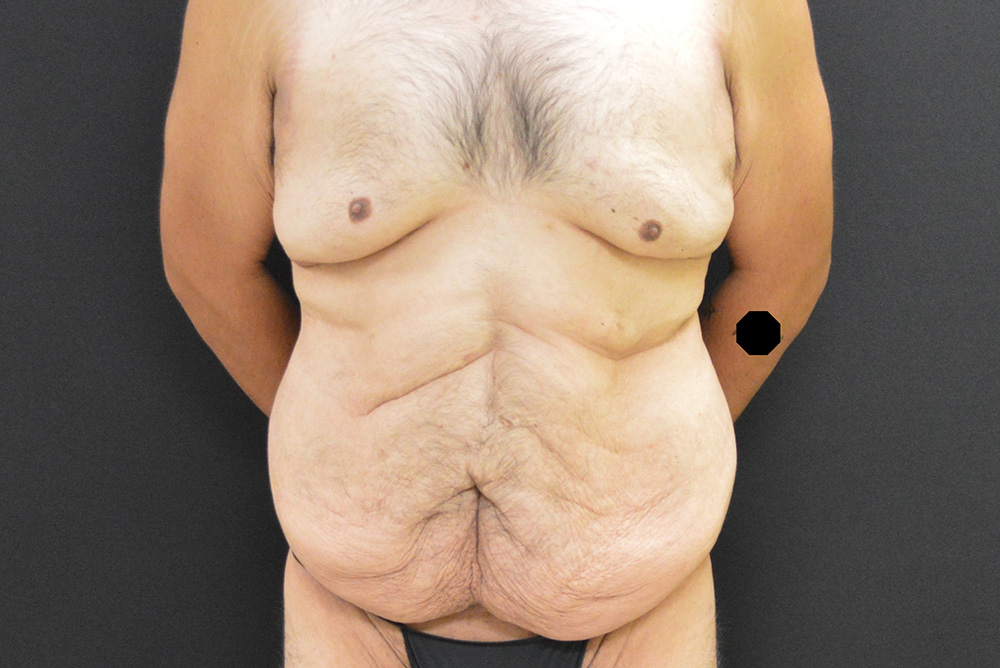 After Massive Weight Loss Patient Photo - Case 291 - before view-