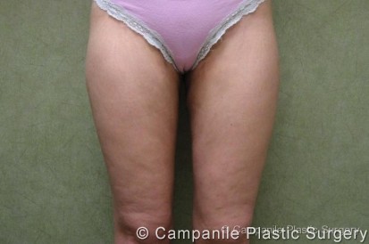 Liposuction Patient Photo - Case 62 - after view