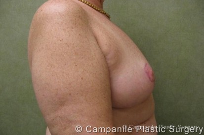 Breast Reduction Patient Photo - Case 167 - after view