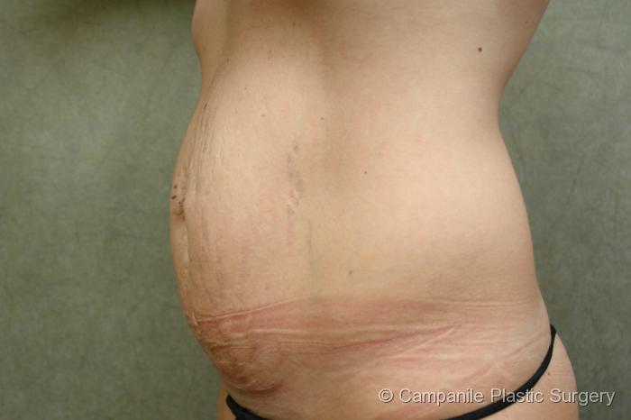 C.L.A.S.S.™ Tummy Tuck Patient Photo - Case 14 - before view-