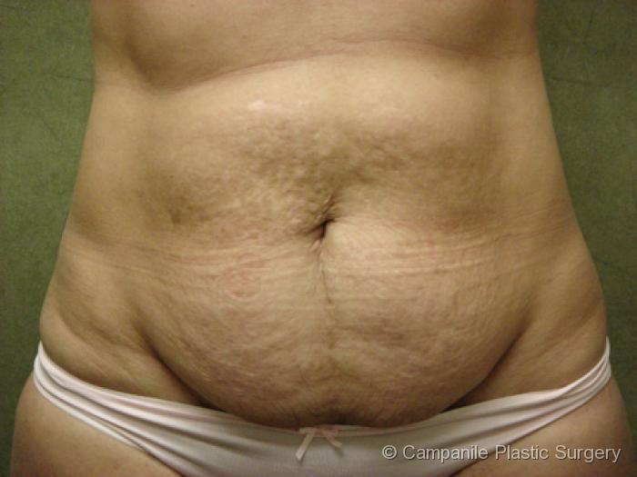 C.L.A.S.S.™ Tummy Tuck Patient Photo - Case 31 - before view-