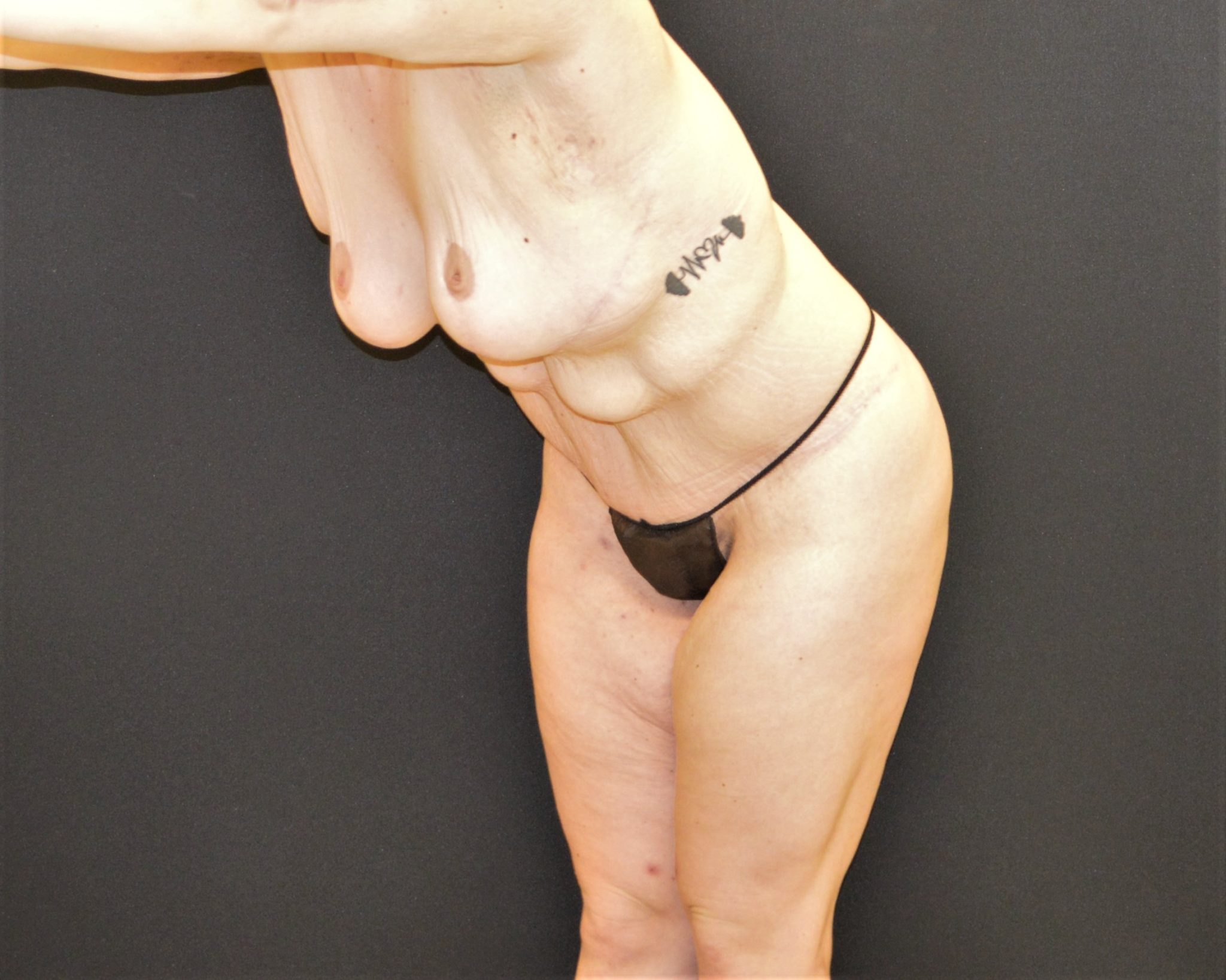 Tummy Tuck Revision Patient Photo - Case 7934 - before view-