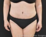 C.L.A.S.S.™ Tummy Tuck - Case 219 - After