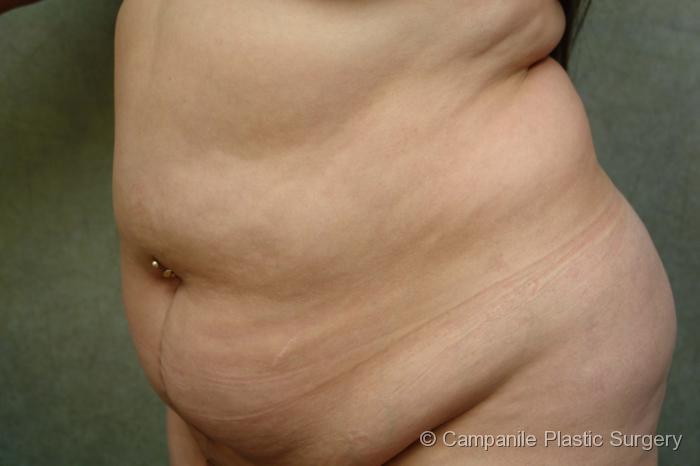 C.L.A.S.S.™ Tummy Tuck Patient Photo - Case 15 - before view-0