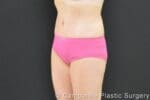 Tummy Tuck - Case 268 - After