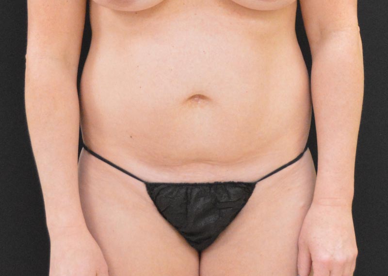 Tummy Tuck Patient Photo - Case 269 - before view-0