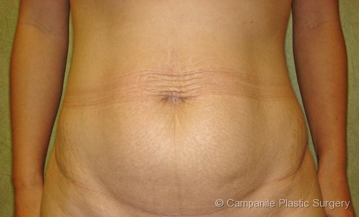 Tummy Tuck Patient Photo - Case 44 - before view-