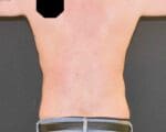 Liposuction - Case 315 - After