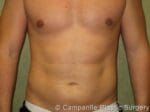 Liposuction - Case 74 - After