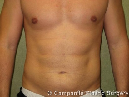 Liposuction Patient Photo - Case 74 - after view