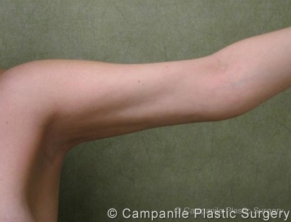 Arm Lift Patient Photo - Case 77 - after view
