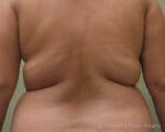Liposuction - Case 69 - Before